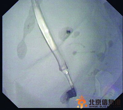 这支“调皮”的牙刷让姜女士吓得不轻。（医院供图）