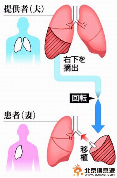 世界首例左右肺逆向移植手术在日本成功实施