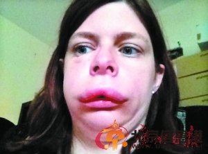 英国一名女子患怪病 身体肿胀似气球
