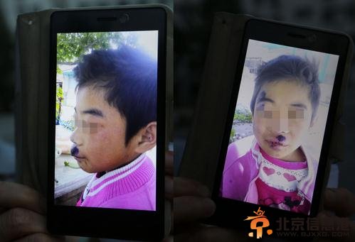 9岁女童国学班“学习”四个月遍体鳞伤【组图】