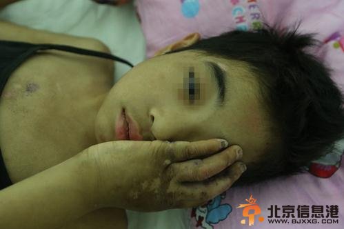 9岁女童国学班“学习”四个月遍体鳞伤【组图】