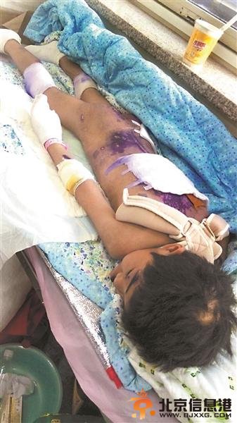 女童遭“国学老师”虐打致多处骨折 被罚吃厕纸