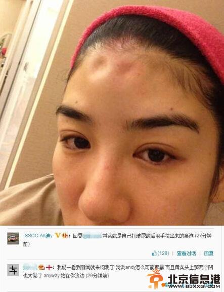 黄奕晒额头被打凹照？ 黄毅清：用玻尿酸伪造