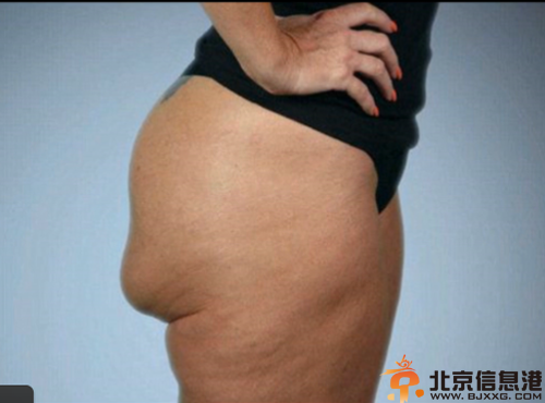 美国脱衣舞女郎雷妮隆臀失败 臀部硅胶可翻转爆红网络