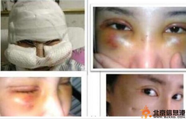 揭郭美美车震事件大尺度比基尼照 其整容过程照片曝光