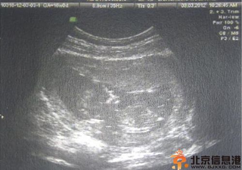 从b超看生男生女秘诀 让自己先了解宝宝性别