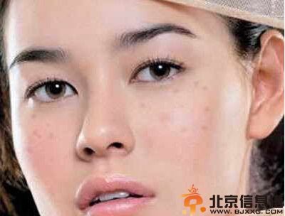 流行的治雀斑的偏方 总有一款适合你