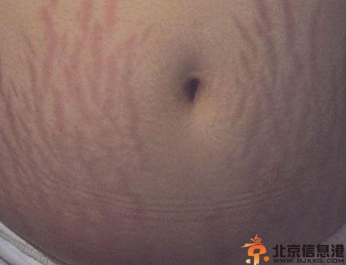 妊娠斑能消除吗 妊娠斑是怎么形成的怎么去除