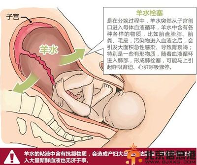 羊水栓塞的原因是什么 羊水栓塞早期症状有哪些