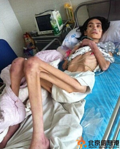 山东女子遭婆婆虐待饿成40斤 因丈夫出轨自杀未遂