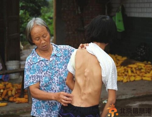 多骨女孩倪敏资料照片现状 身患怪病忍痛求学