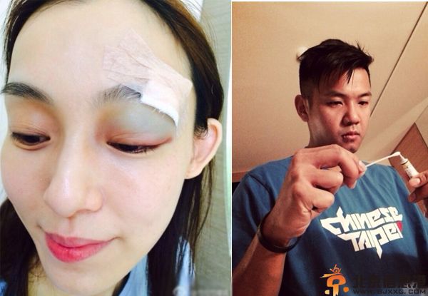 范玮琪脸部受伤图片曝光 缝25针吓坏黑人建州