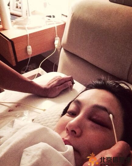 范玮琪摔倒缝针眼睛红肿 黑人悉心照料