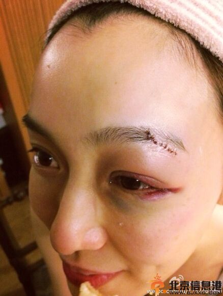 范玮琪摔倒缝针眼睛红肿 黑人悉心照料