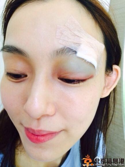 范玮琪摔倒缝针眼睛红肿 黑人悉心照料