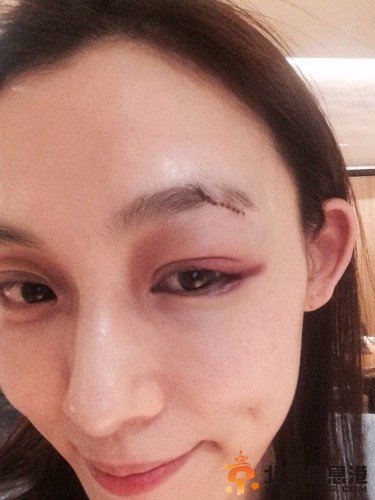 范玮琪摔倒左眼缝20多针 网友：这是要家暴的节奏吗