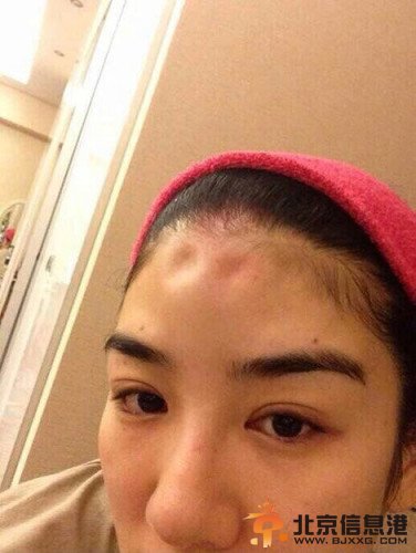 黄奕伪造家暴照片曝光 额头打玻尿酸肿胀凹陷