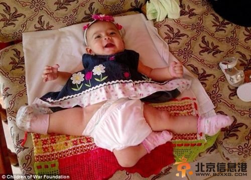 巴拿马“三腿女婴”赴美免费切除第三条腿 体内还有三个肾