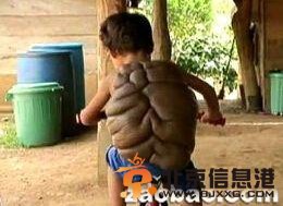哥伦比亚乌龟壳男孩：身背巨瘤像乌龟一样被人嘲笑（图）