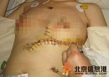 印度皮条客强逼女子卖淫被拒 用灼烫熨斗割其双乳