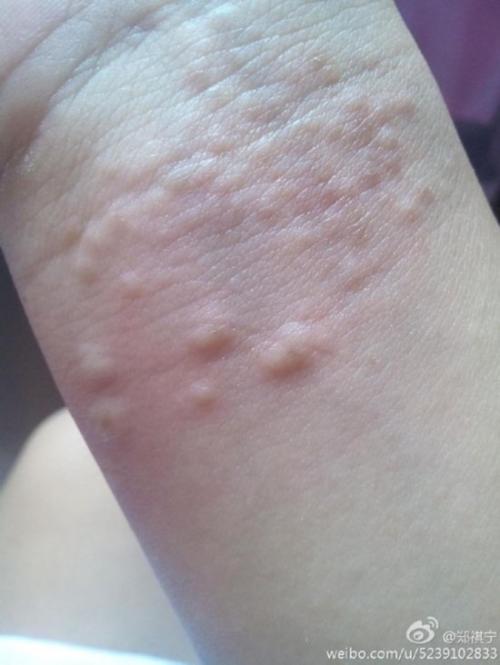 最美癌症女孩死亡 癌症晚期被放弃治疗【组图】