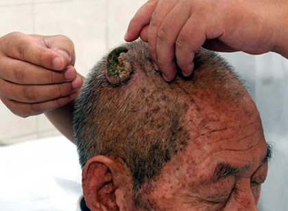 图:河南88岁老人头上长5厘米