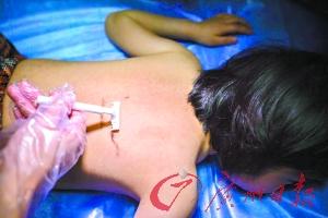 9岁女童得怪病 因服用廉价激素药物致全身长毛