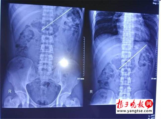 小伙因父母不满意女友吞下烧烤钎一月后就医（图）