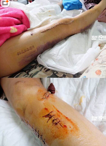 河南美女主播下班途中被宝马撞伤 美腿近二十厘米伤口至今肇事司机未找到