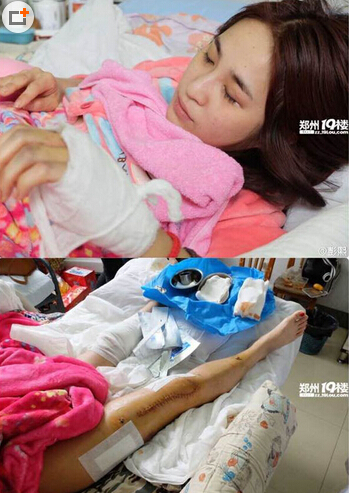 河南美女主播下班途中被宝马撞伤 美腿近二十厘米伤口至今肇事司机未找到