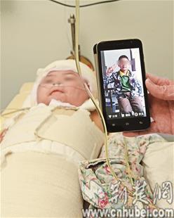 9岁男孩被高压感应电灼伤外生殖器大部分坏死（图）