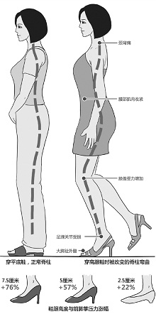 女子穿高跟鞋30年脚趾挤成三角形被要求截趾（图）