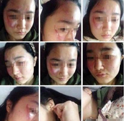 湖北一女教师与女生互殴 受伤学生脸上有多道血痕